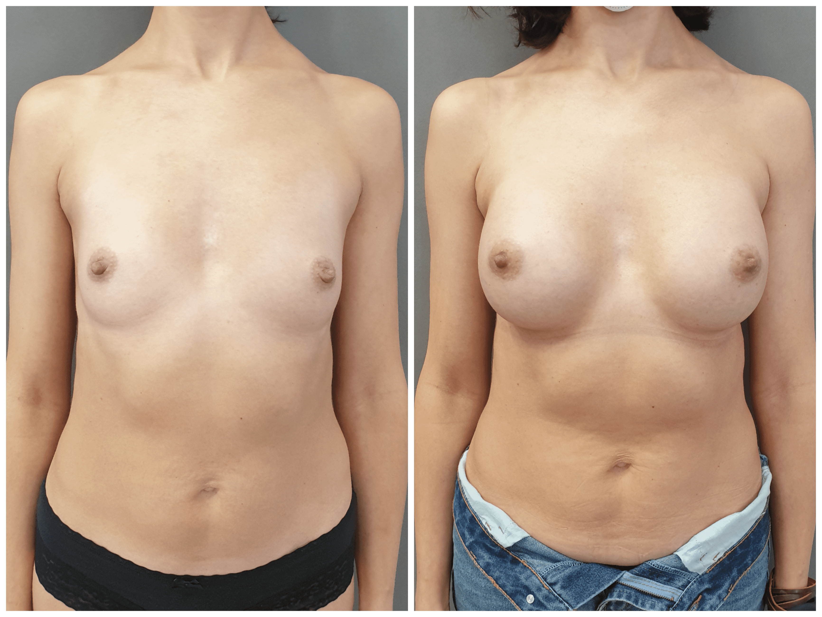 увеличилась грудь причины у женщин фото 65